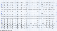 ECG miniature