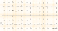 ECG miniature