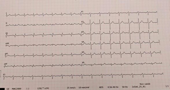 Aspect de S1Q3T3 chez une patiente présentant une embolie pulmonaire à risque intermédiaire élevée.