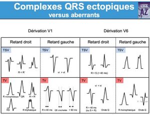 Complexe QRS.jpg