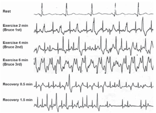 ECG test d'effort TVPC .png