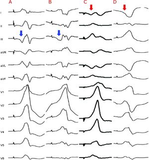 TV épicardique vs TV endocardique.jpg