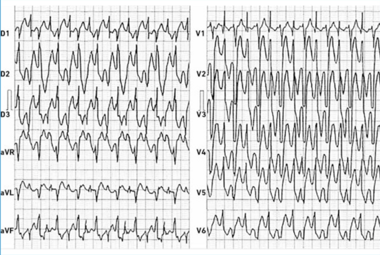 ECG - TV polymorphe .png