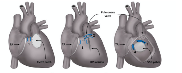 Isthmes anatomiques de tachycardie ventriculaire sur tétralogie de Fallot [2]