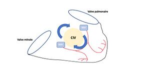 Circuit d'une tachycardie jonctionnelle par deux noeuds atrio-ventriculaires ( double discordance avec CIV sous pulmonaire )
