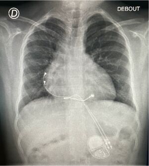 Radiographie du thorax de face : pacemaker épicardique chez une enfant de 5 ans pour BAV immun