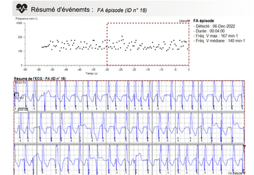 Enregistrement d'une FA sur un MCI en télécardiolgie
