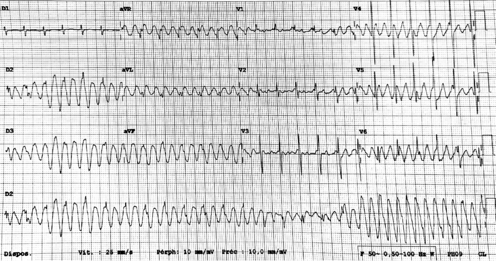 Tremblements des membres mimant une tachycardie ventriculaire