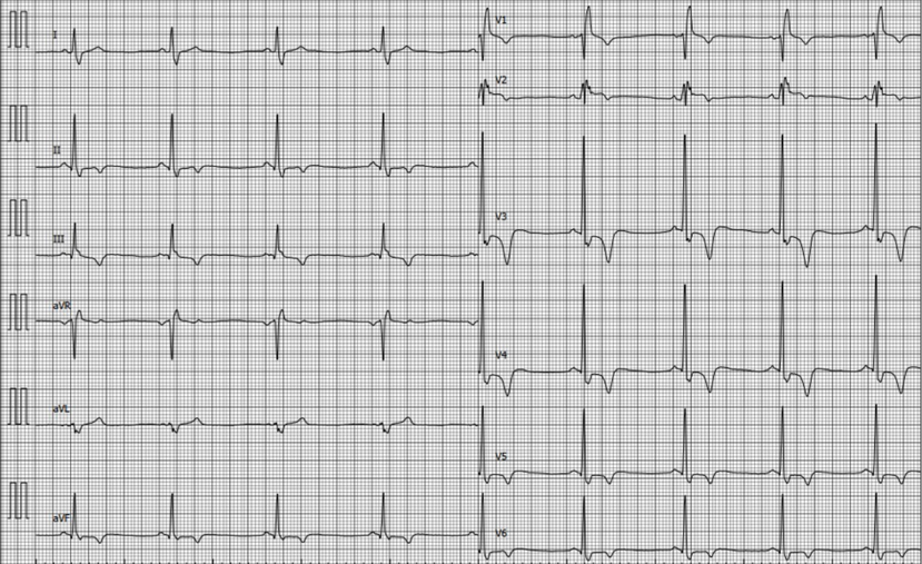 ECG CMH 4.png