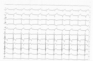 ECG CMH 3.png